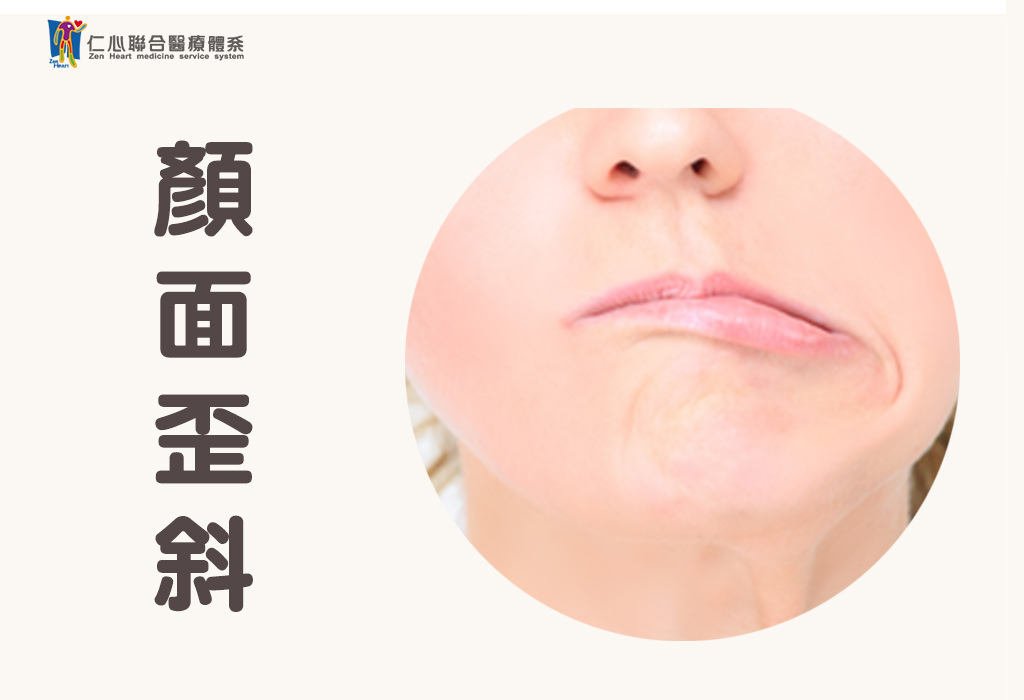 顏面神經麻痺
