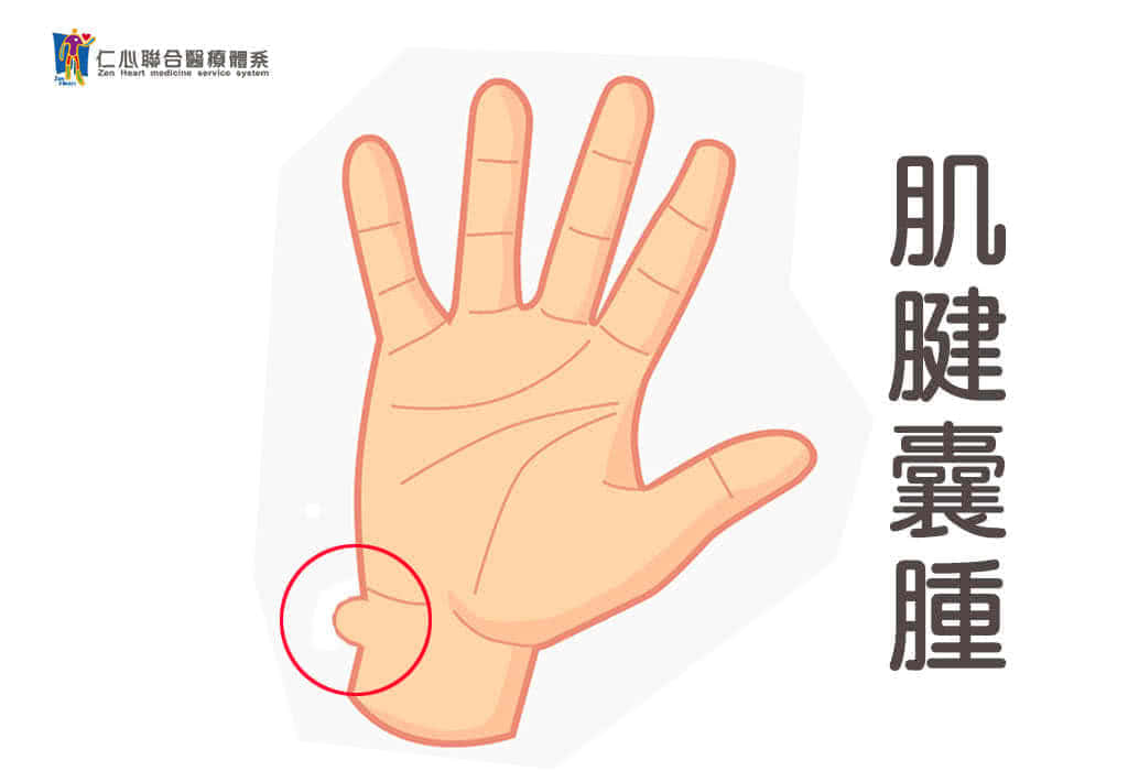 肌腱囊腫